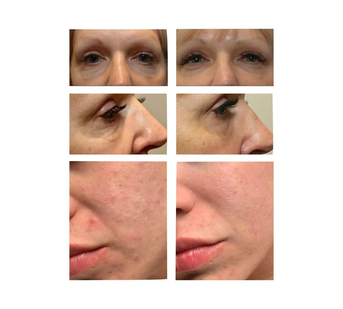 Load image into Gallery viewer, Morpheus 8 - Skin Tightening Treatment-thesaloncranleigh

