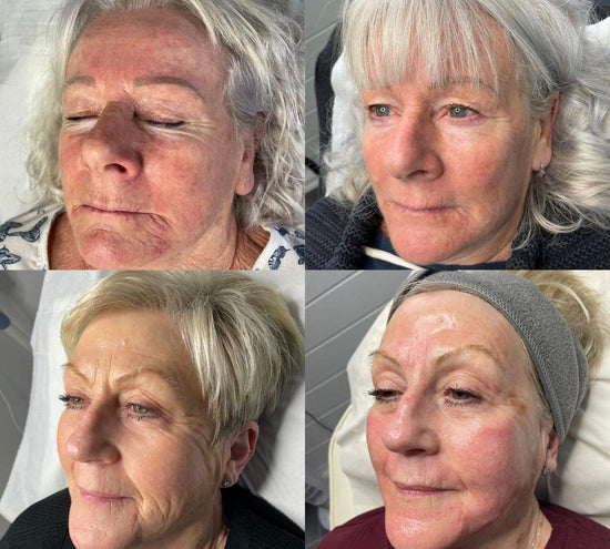 Load image into Gallery viewer, Seventy Hyal 2000 - Next Generation Skin Booster - Consultation-thesaloncranleigh
